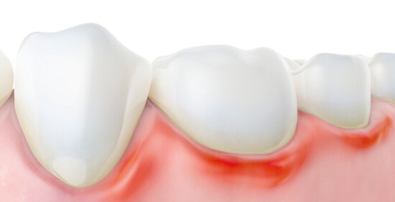 Doença Periodontal Doença Periodontal